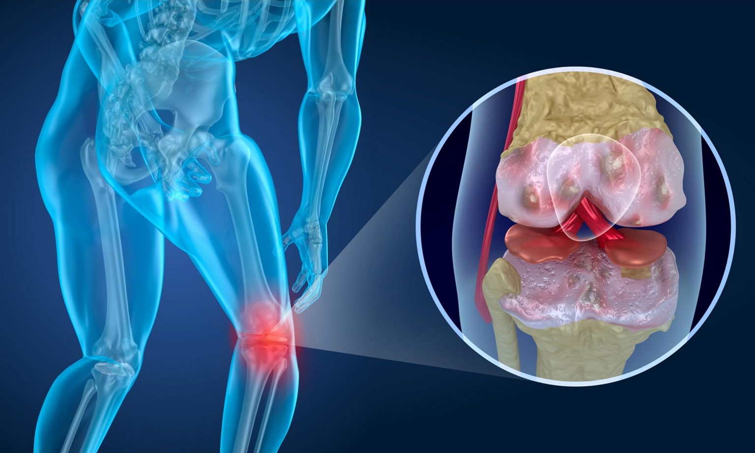Concept of knee pain – illustration showing joint inflammation, discomfort, and medical diagnosis.