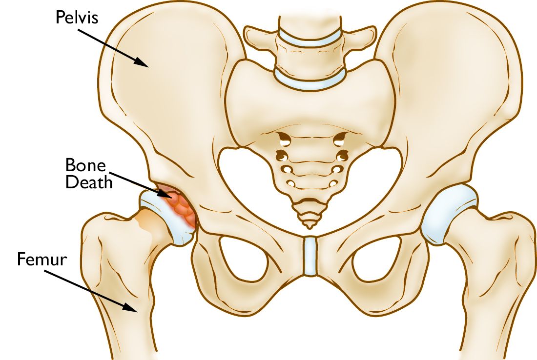 Illustration of hip joint disorders showing joint degeneration, inflammation, and bone structure abnormalities.