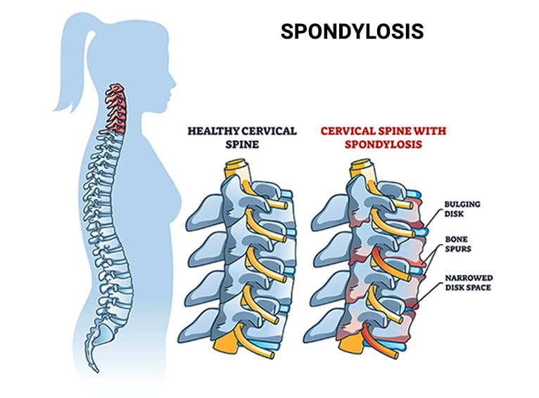 Cervical spondylosis diagram showing healthy cervical spine vs cervical spine with spondylosis, including bulging disc, bone spurs, and narrowed disc space – NBR Clinic