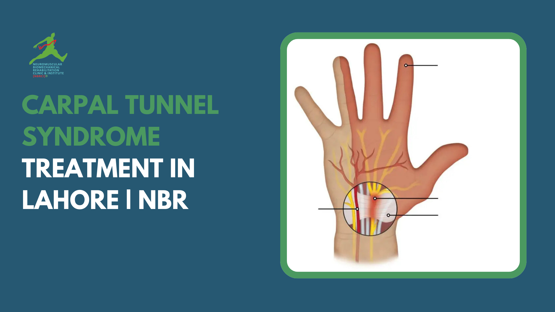 Carpal Tunnel Syndrome Treatment in Lahore | NBR Clinic & Dr. Riaz Ahmed