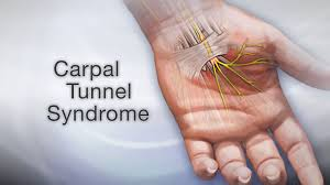 Early Warning Signs of Carpal Tunnel Syndrome You Shouldn’t Ignore
