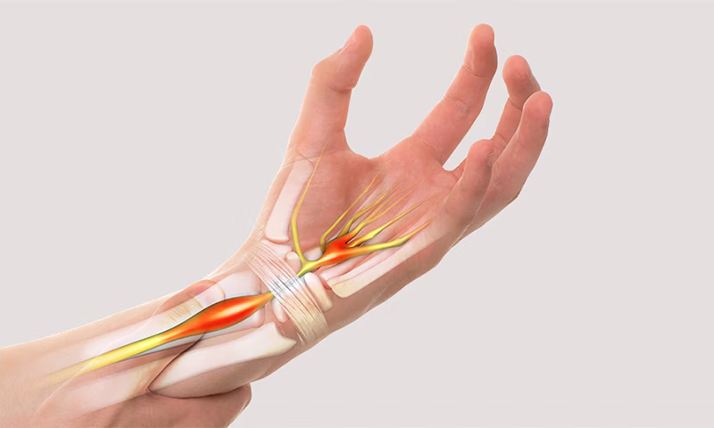 Carpal Tunnel Syndrome Treatment in Lahore | NBR Clinic & Dr. Riaz Ahmed